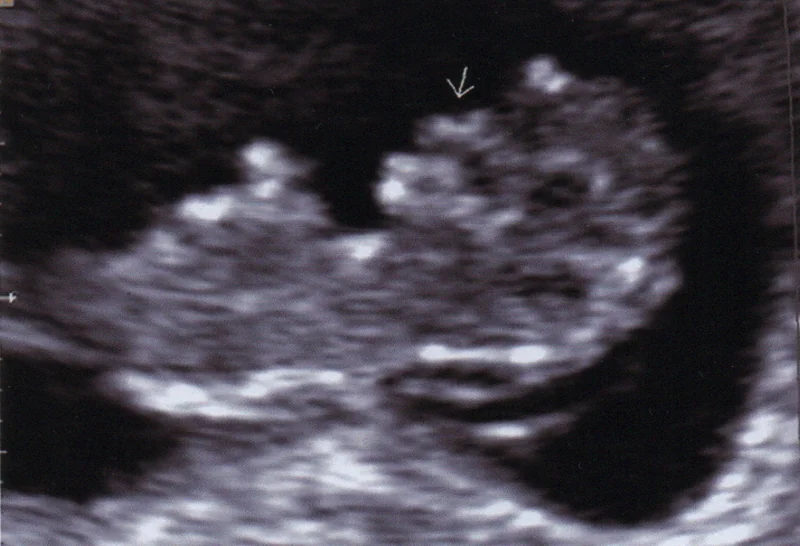 Ecografía del bebé de Alejandro y Elizabeth